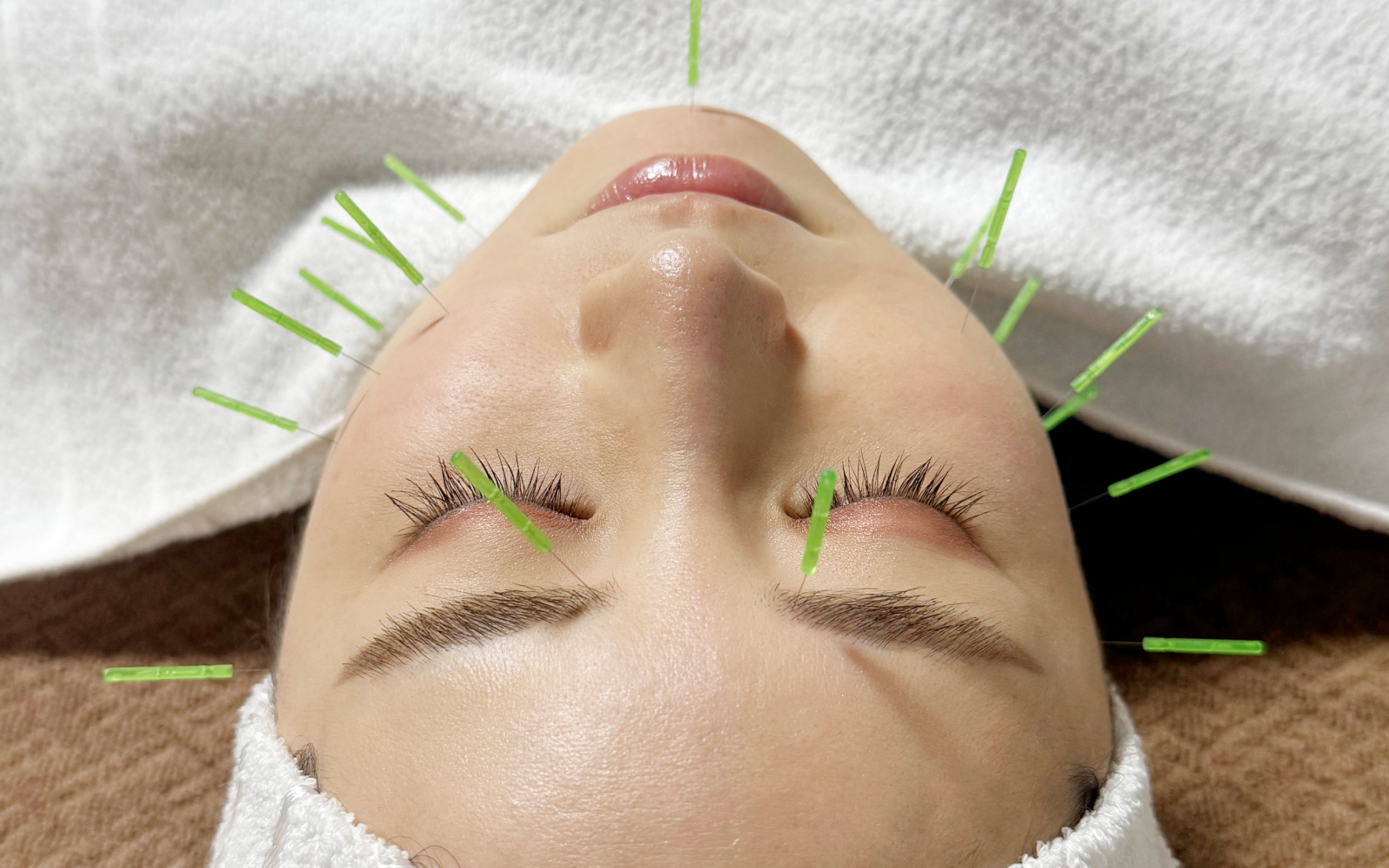 美容鍼